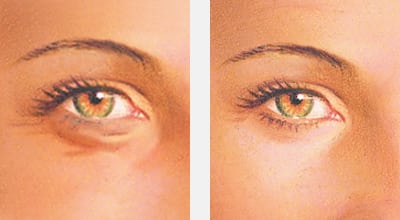 Before and after lower eyelid blepharoplasty - eyelid surgery albany ny