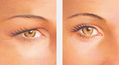 Before & after upper eyelid lift surgery (blepharoplasty) - eyelid surgery albany ny
