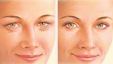 Eyelid Lift - Before & After Artist Example - eyelid surgery albany ny