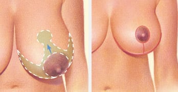 breast reduction albany ny