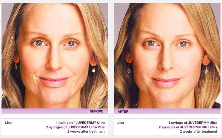 Juvederm - Before & After Example