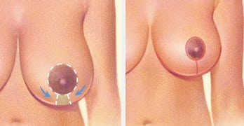 breast reduction albany ny