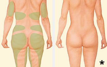 Before & after liposuction of the hips, thighs, buttocks & lower back. - liposuction albany ny