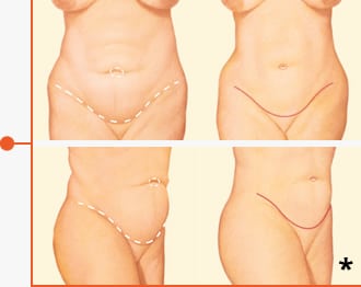 Before & After Tummy Tuck Photo Example