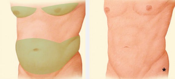 Before & after male liposuction of the stomach, abdomen & chest - liposuction albany ny