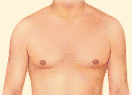 After gynecomastia surgery - example diagram After gynecomastia surgery example