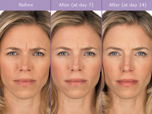 Botox Albany, NY DeLuca Plastic Surgery