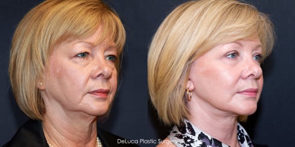 Face Q&A: For Sunken Hollow Cheeks, Fillers, Fat Injections or Facelift? Before & after facelift on face with sunken cheeks and jowls