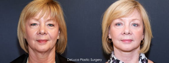 Face Q&A: For Sunken Hollow Cheeks, Fillers, Fat Injections or Facelift? Before & after facelift on face with sunken cheeks and jowls