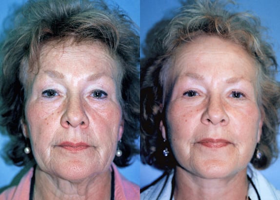 Face Q&A: For Sunken Hollow Cheeks, Fillers, Fat Injections or Facelift? Before & After SMAS Facelift - note how the saggy tissue has been moved from the jowls to the upper and mid face.