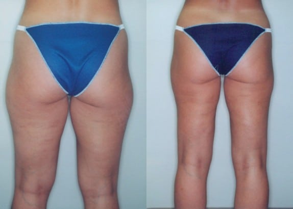 Before & after liposuction of the hips and thighs to remove "saddlebags" (2200cc infused and 2100cc removed) - by Dr. DeLuca Before & after liposuction of the hips and thighs to remove "saddlebags" (2200cc infused and 2100cc removed) - by Dr. DeLuca
