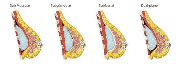 Breast implant position options - submuscular vs subglandular vs subfascial vs dual plane