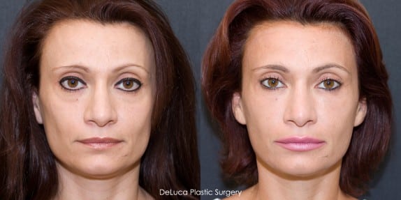 Before & after Sculptra filler for sunken hollow cheeks Before & after dermal filler for sunken hollow cheeks