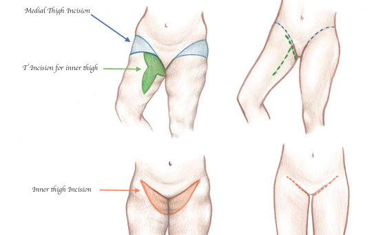 Thigh Lift Albany NY DeLuca Plastic Surgery