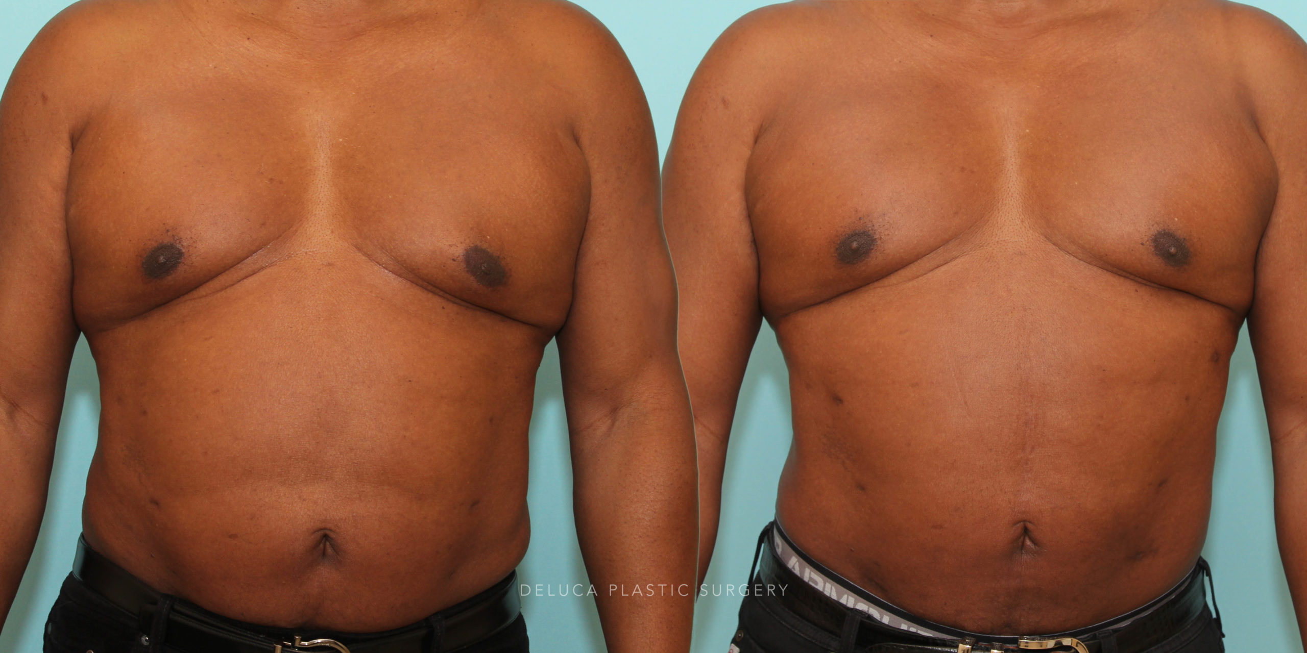 60 Year Old Male Liposuction of The Abdomen