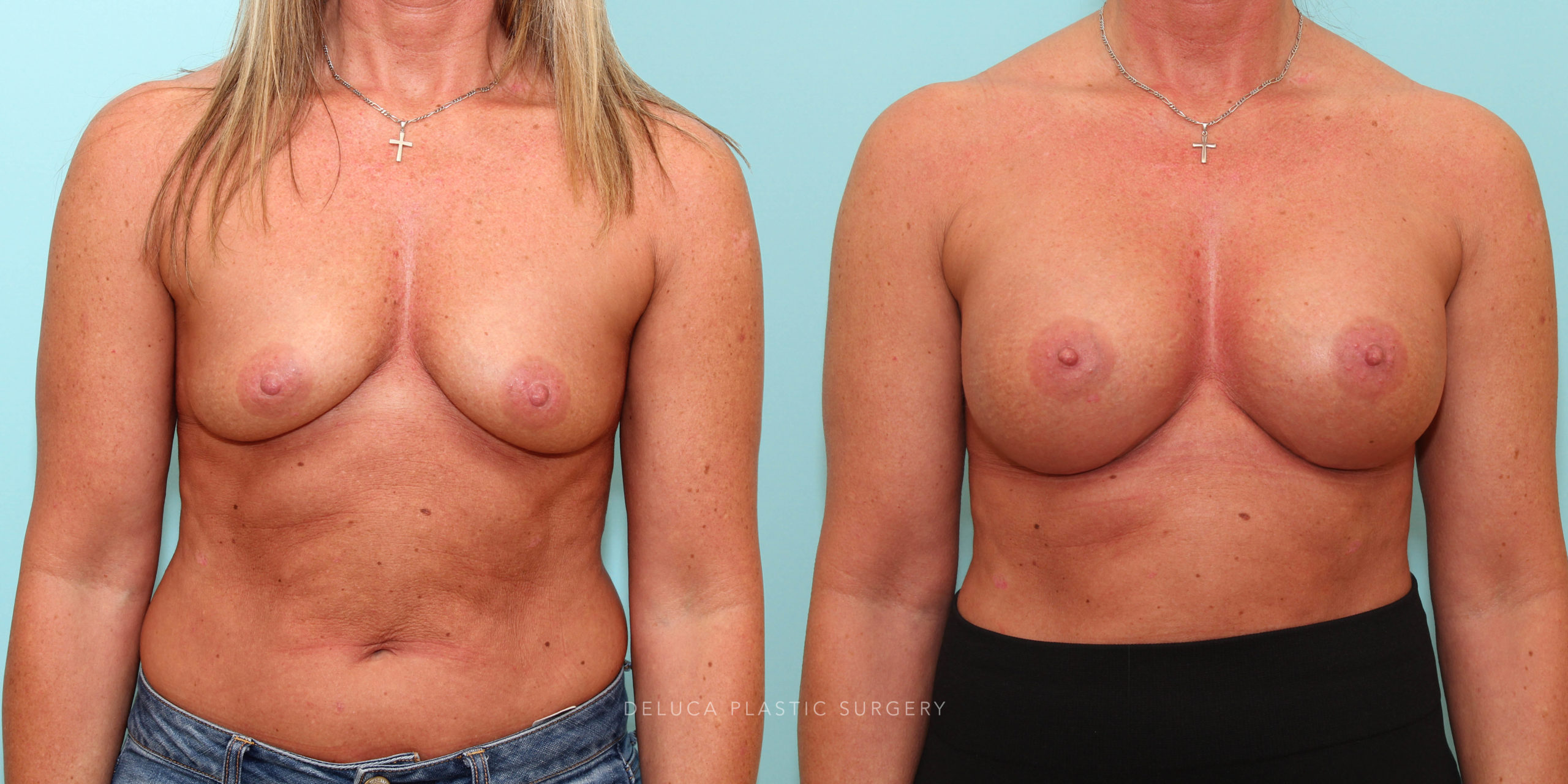 30 Year Old Asymmetric Breast Augmentation