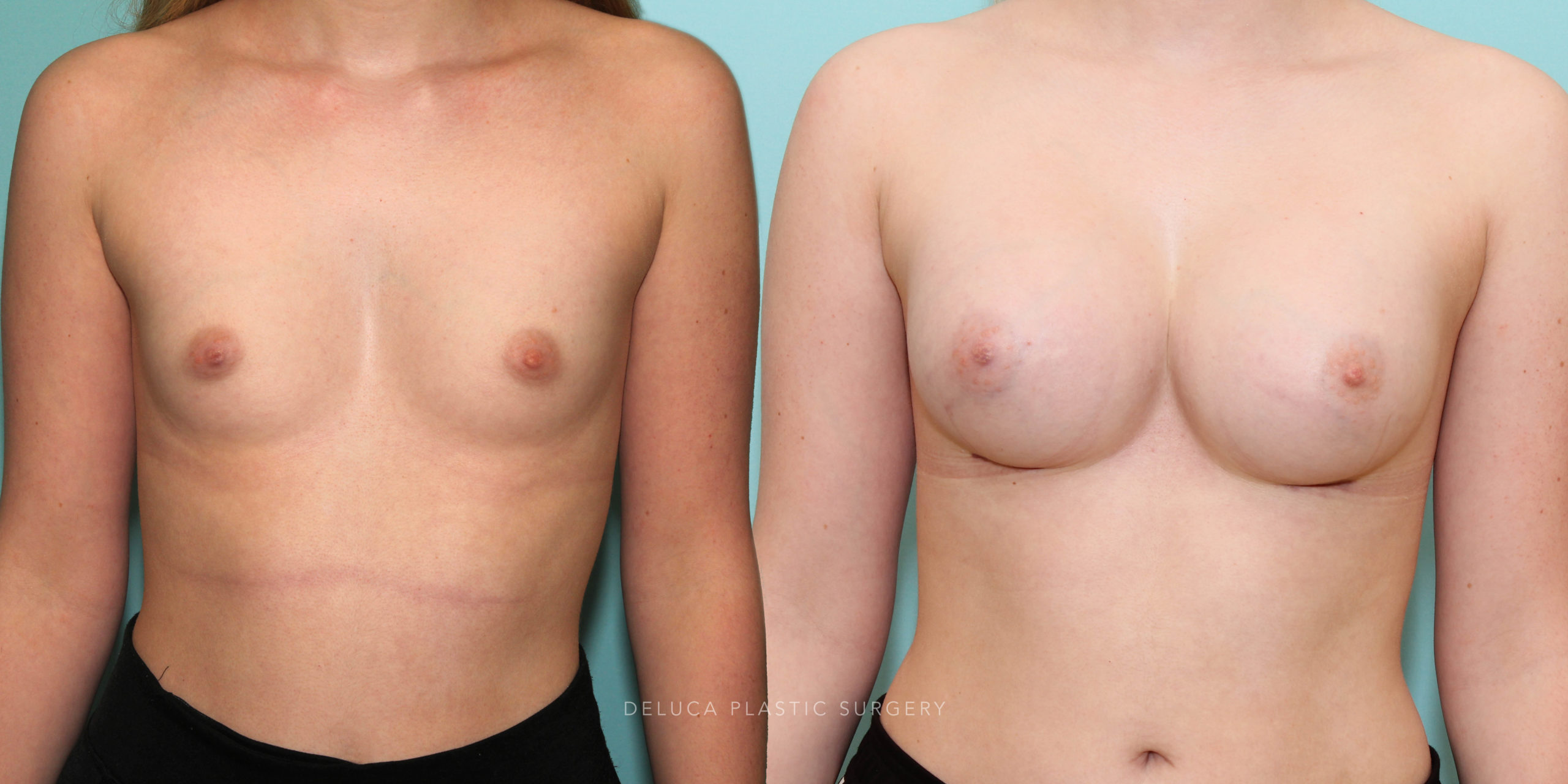 19 y/o Dual Plane Augmentation with 480 HP Saline