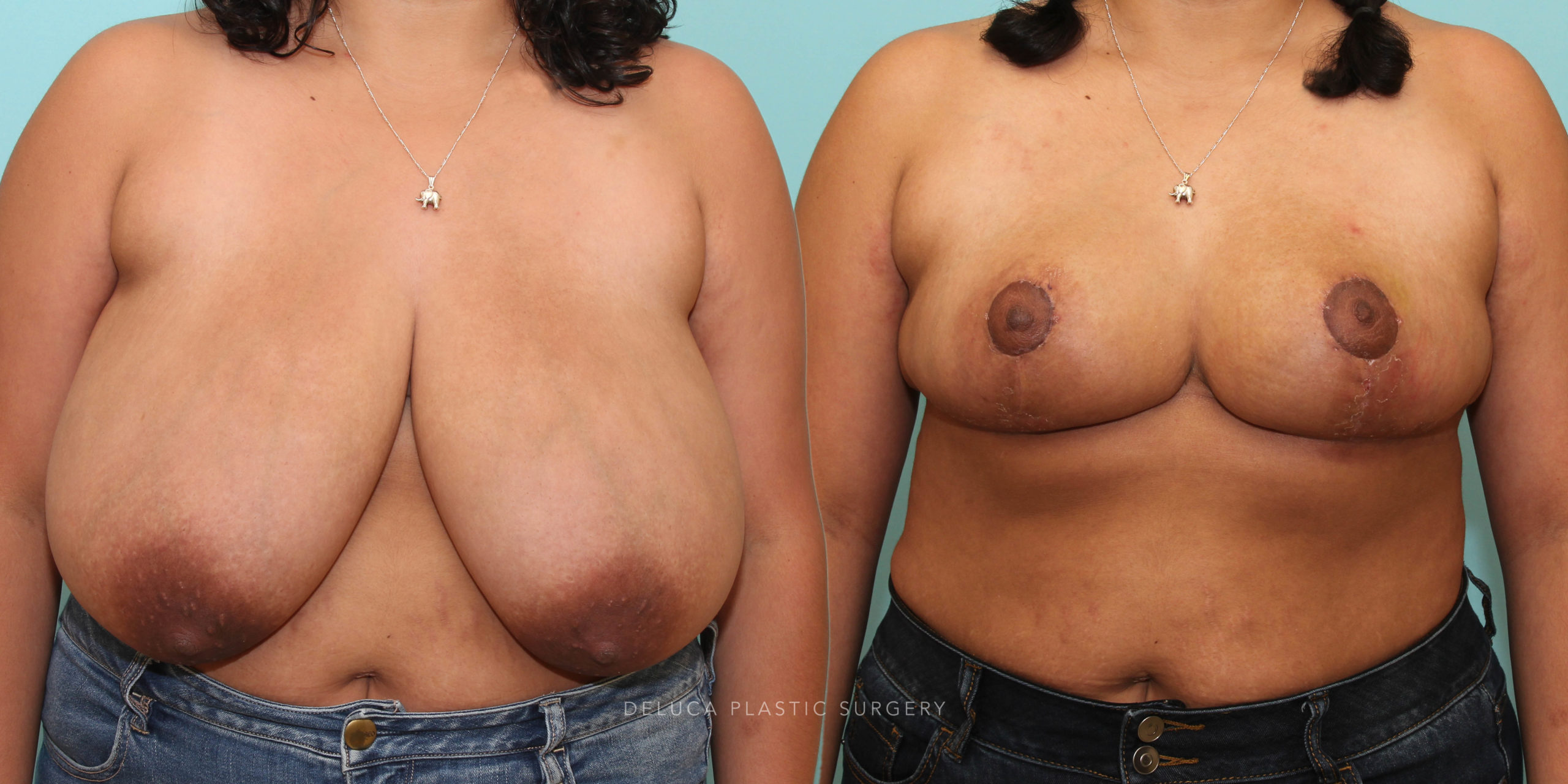 28 y/o 1600 gram Inferior Pedicle Short Scar Wise Pattern Reduction