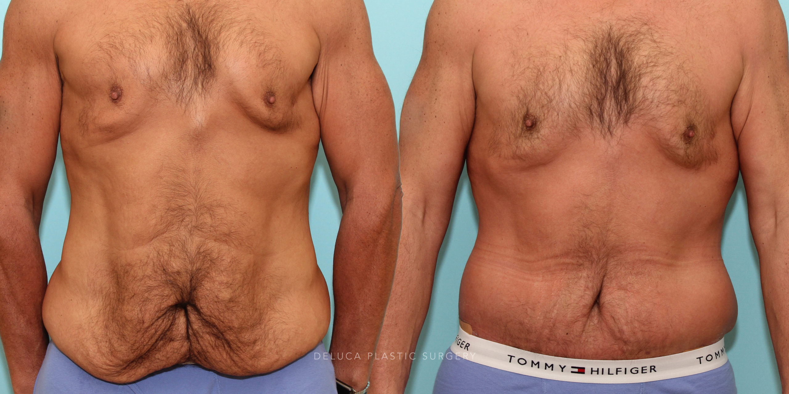 44 y/o Tummy Tuck and Lipo After Massive Weight Loss