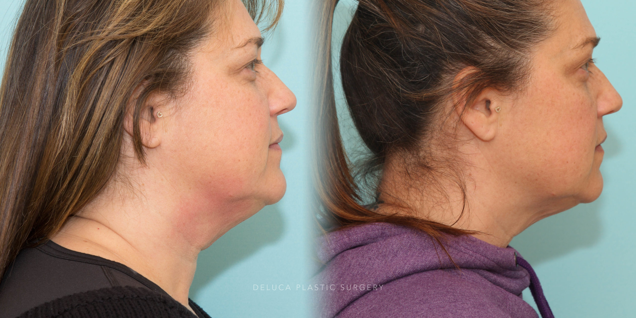 51 y/o Kybella Injections for Neck Fat (2 Treatments)