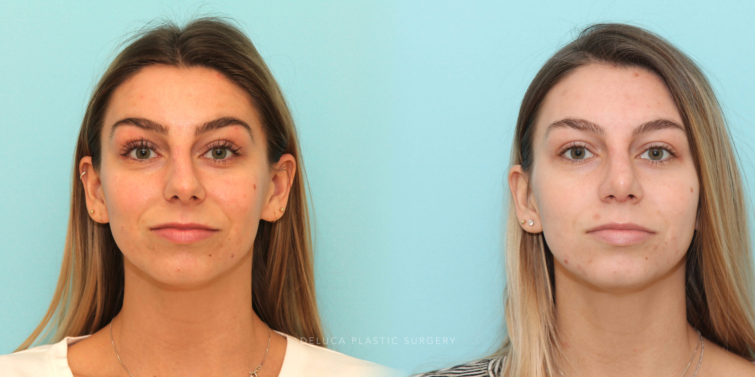 23 y/o Septoplasty Hump Reduction and Tip Rhinoplasty