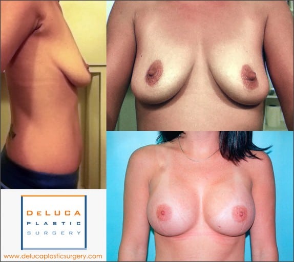Perfect Breast Augmentation Example Before & After Photo