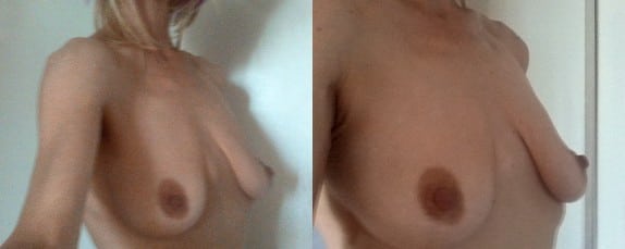 Deflated breasts before surgery - lift & implant needed to obtain the best possible result