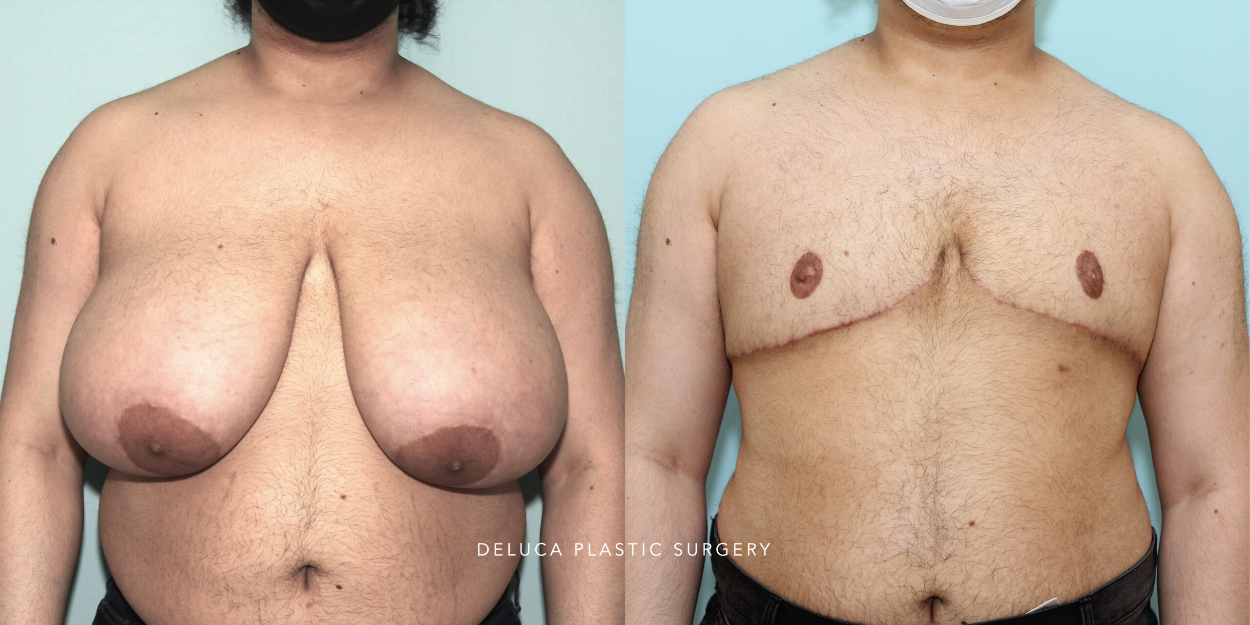 23 y/o FTM/NB Top Surgery With Mastectomy and Nipple Graft