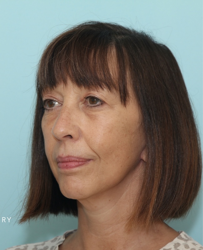 After face and neck rejuvenation