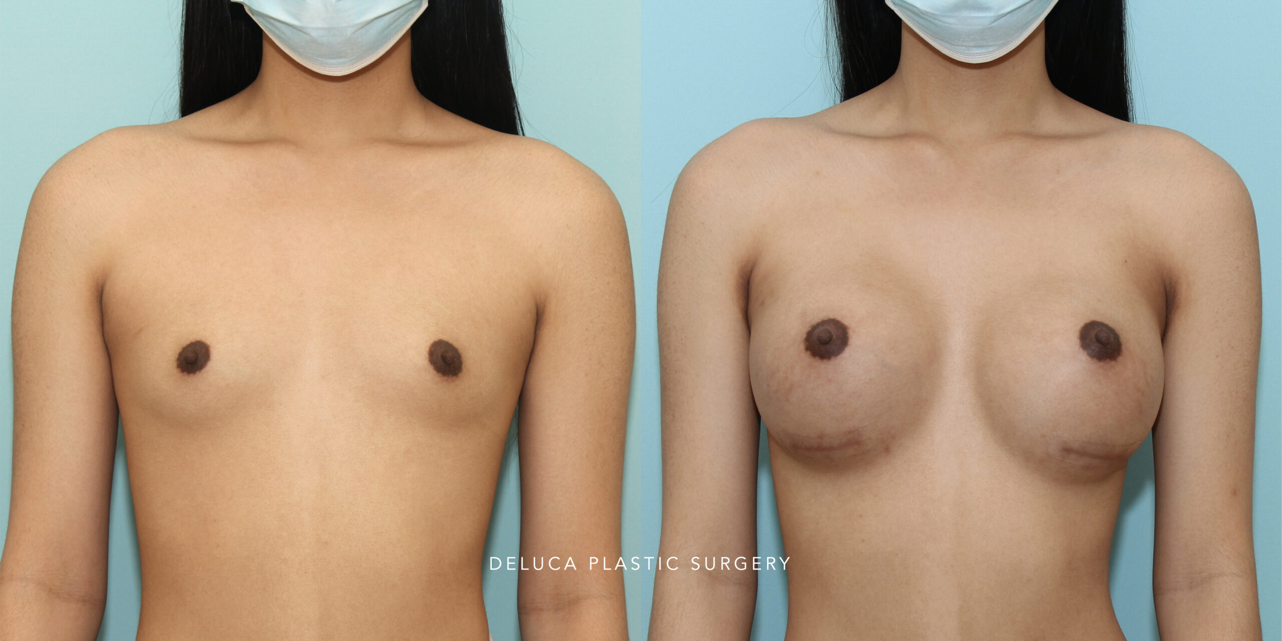 25 y/o MTF Top Surgery With 500ml HP Silicone Implant