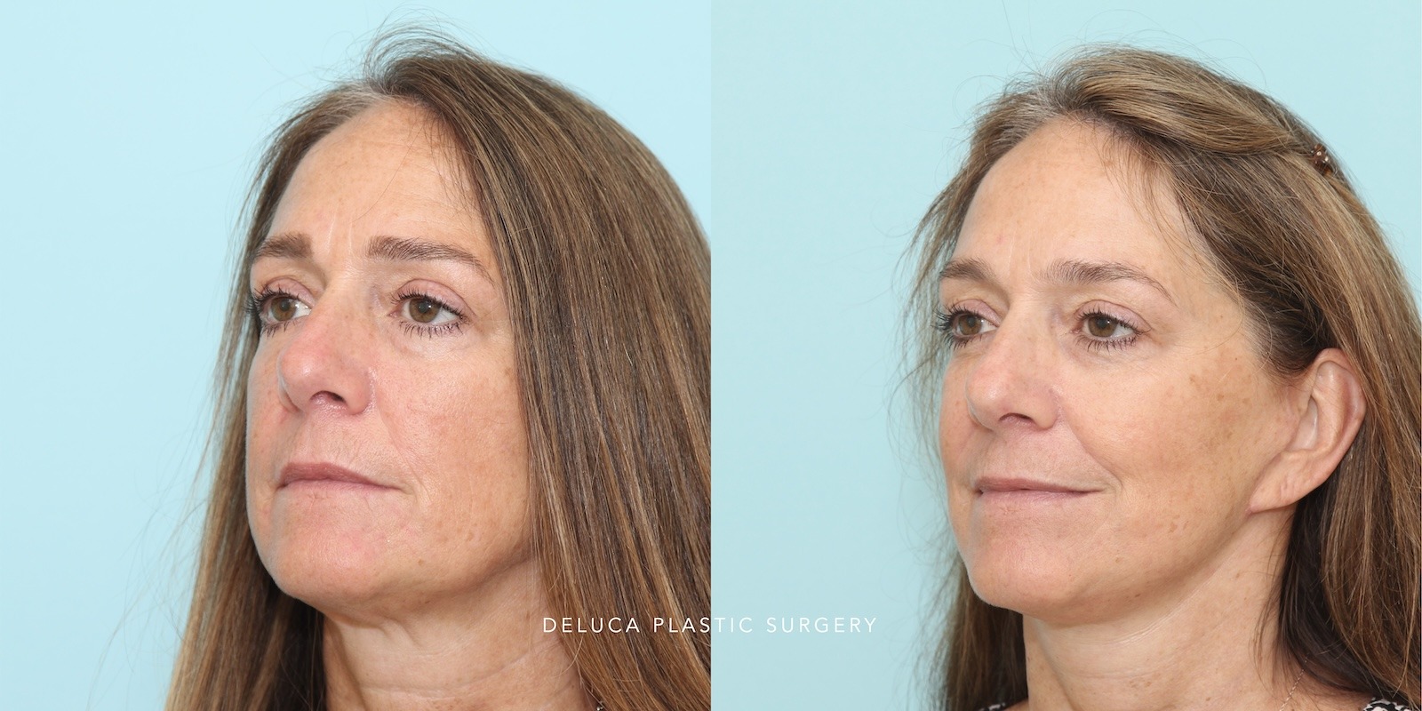 Face and neck lift before and after