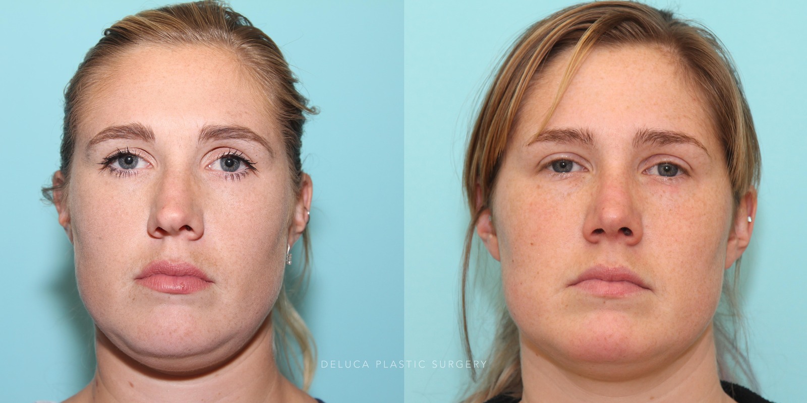 27 y/o Rhinoplasty with Tip Refinement