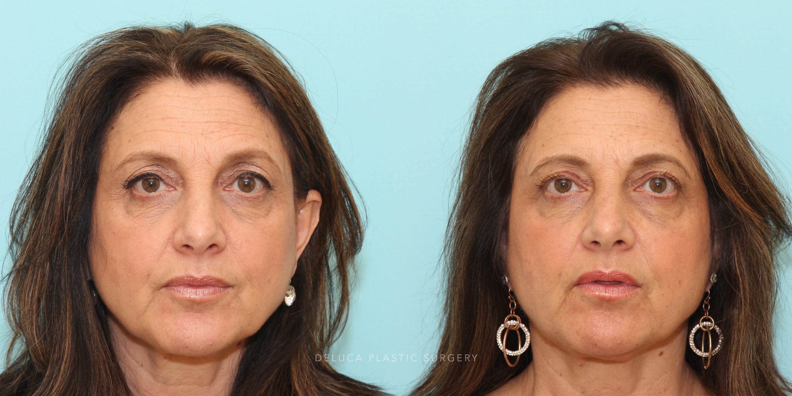 58 y/o Upper Lid Pinch Blepharoplasty