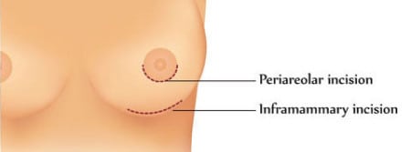 Breast Implant Incisions: Periareolar and Inframmammary