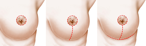Breast Lift Incisions: Peri-Areolar, Lollipop, and Inverted "T"