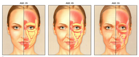 Stages Of Facial Volume Loss in The Thinning Face