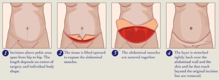Full Tummy Tuck Diagram