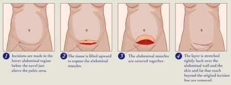 Mini Tummy Tuck Diagram
