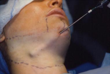Treating Neck Fat with Neck Liposuction