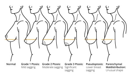 Saggy Breasts, Breast ptosis : sagging breast fix surgery, breast lift non  surgical