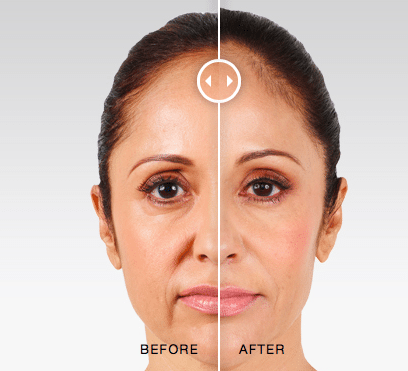 Injectables - Juvederm Before and After