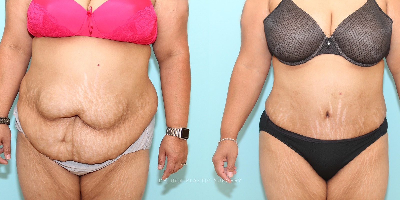 39 y/o Tummy Tuck and Liposuction Abdomen