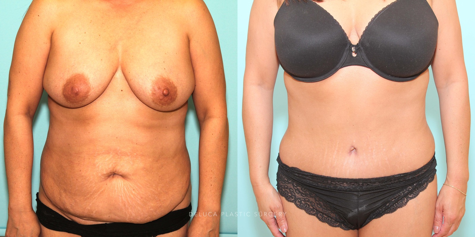48 y/o Tummy Tuck and Liposuction Abdomen