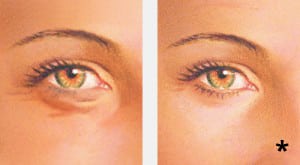Before and after lower eyelid blepharoplasty - eyelid surgery albany ny