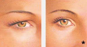 Before & after upper eyelid lift surgery (blepharoplasty) - eyelid surgery albany ny
