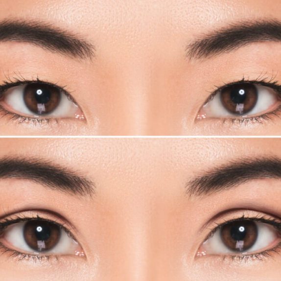 Before/after of blepharoplasty surgery  on an Asian woman