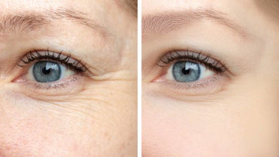 before and after photos showing the effects of botox treatment on aging