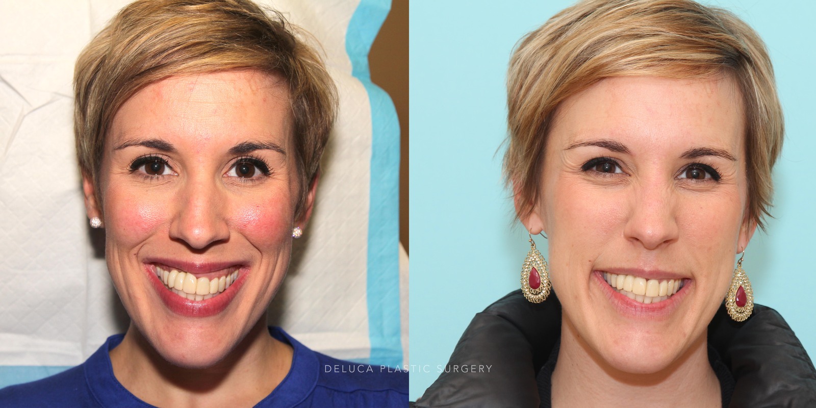 35 y/o Botox Correction of A Gummy Smile