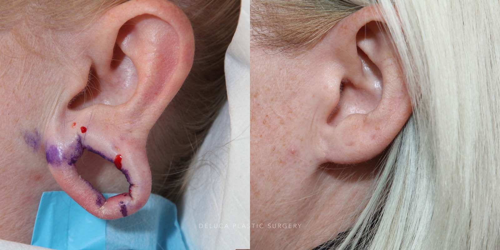 37 y/o Closure of Gauge Earring Holes