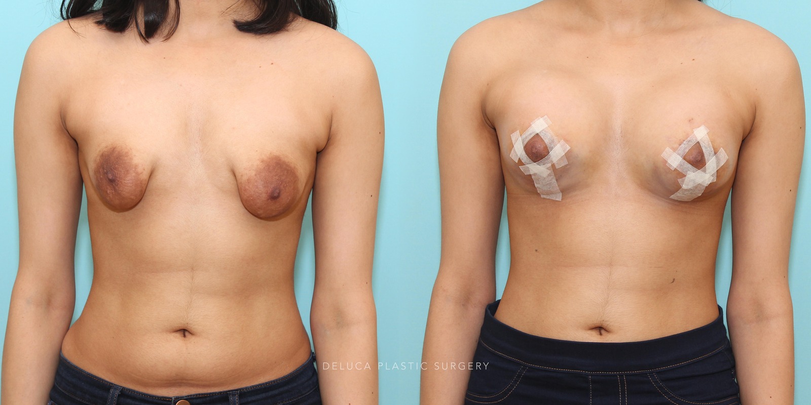 Correction of server tuberous breast deformity in a 22 year old young woman